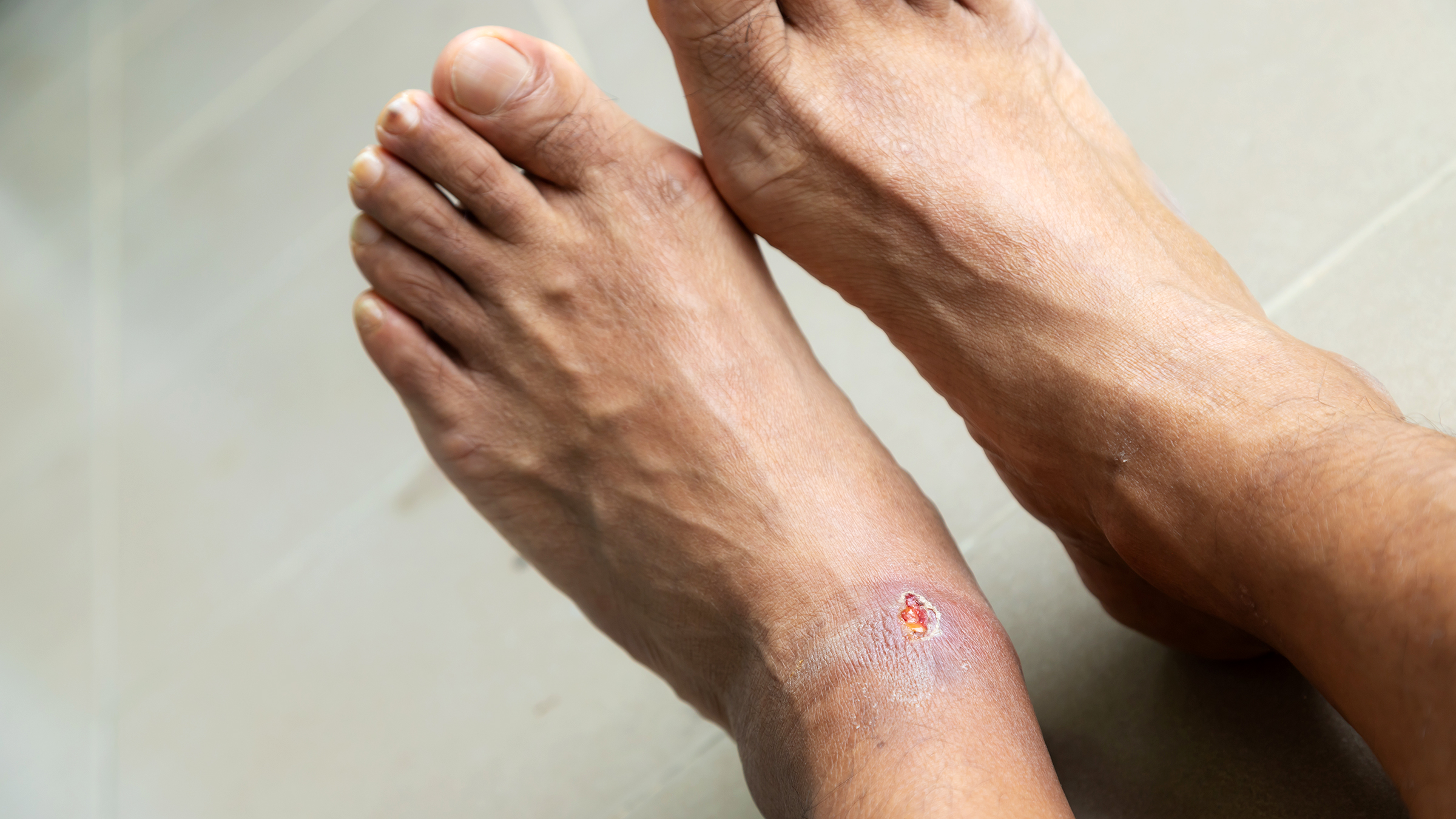 Luka di Kaki Sulit Sembuh? Bisa Jadi Tanda Diabetes